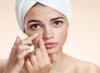 MalabarNews_acne face