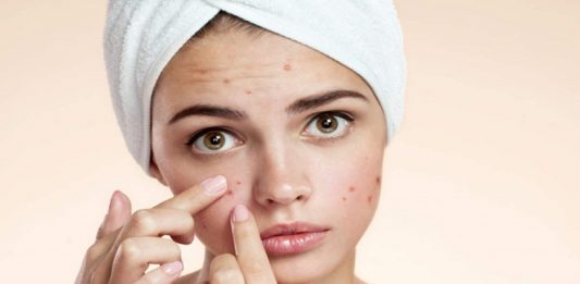 MalabarNews_acne face