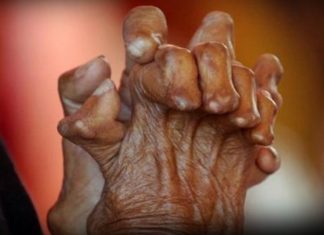 ജനുവരി 30 ദേശീയ കുഷ്ഠരോഗ നിര്മാര്ജന ദിനം; ബോധവല്ക്കരണ ക്യാംപയിനുമായി സർക്കാർ leprosy