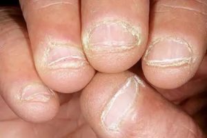nail loss