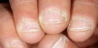 nail loss