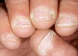 nail loss