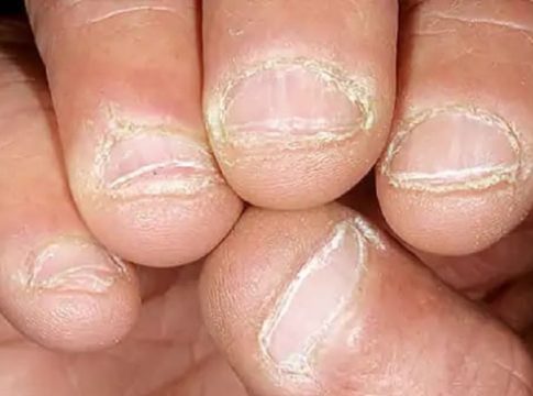 nail loss