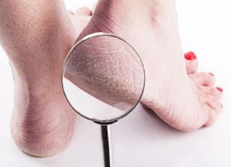 cracked legs-remedies