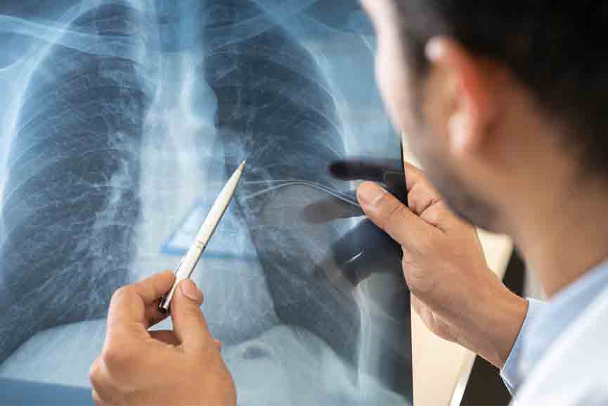 tuberculosis Akshaya Kerala again to find TB patients