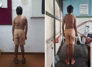 ജിത്തുവിന് നിവര്ന്നു നില്ക്കാന് സൗജന്യ ശസ്ത്രക്രിയ; അഭിനന്ദിച്ച് ആരോഗ്യമന്ത്രി shubhavartha