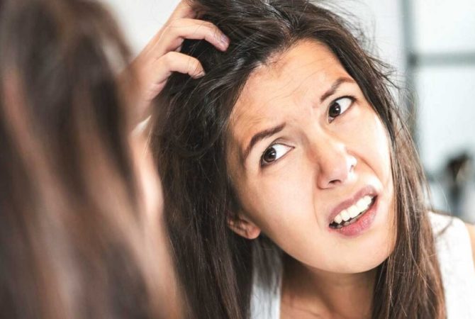 dandruff-solutions