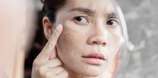 മുഖത്തെ കറുത്ത പാടുകള് അകറ്റാൻ ഇതാ ചില ടിപ്സ് dark spot-face