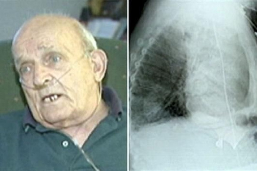 pea plant growing in 75 year old mans lungs