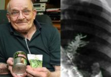 pea plant growing in 75 year old mans lungs