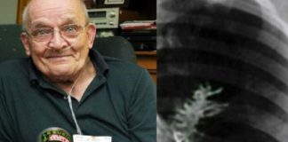 ശ്വാസകോശത്തിൽ പയറുചെടി വളർന്നെന്നോ? 75കാരന്റെ കഥ ഇങ്ങനെ pea plant growing in 75 year old mans lungs