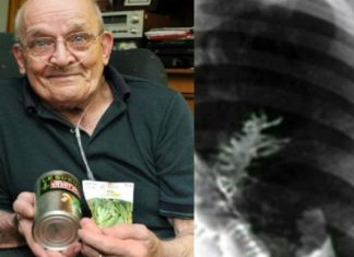 pea plant growing in 75 year old mans lungs