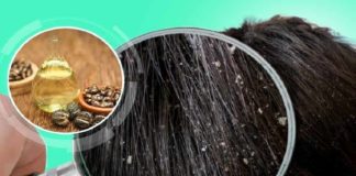 താരൻ അകറ്റാൻ ആവണക്കെണ്ണ; ഗുണങ്ങൾ അറിയാം