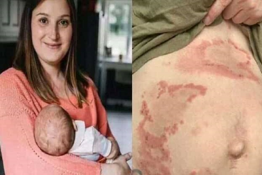 Mother's rare disorder makes her allergic to own baby
