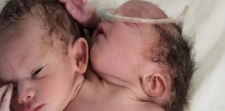 Baby is born with two heads, three arms