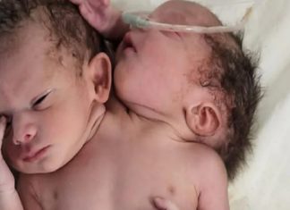 കുഞ്ഞ് ജനിച്ചത് രണ്ട് തലയും മൂന്ന് കൈകളുമായി; അത്യപൂർവം Baby is born with two heads, three arms