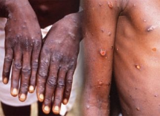 Monkey Pox Reported In Israel And 100 Cases In 12 Countries