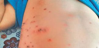 Scrub Typhus Confirmed In Thirur In Malappuram