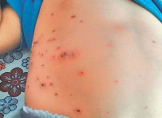 മലപ്പുറത്ത് ചെള്ളുപനി സ്ഥിരീകരിച്ചു; യുവതി ചികിൽസയിൽ Scrub Typhus Confirmed In Thirur In Malappuram