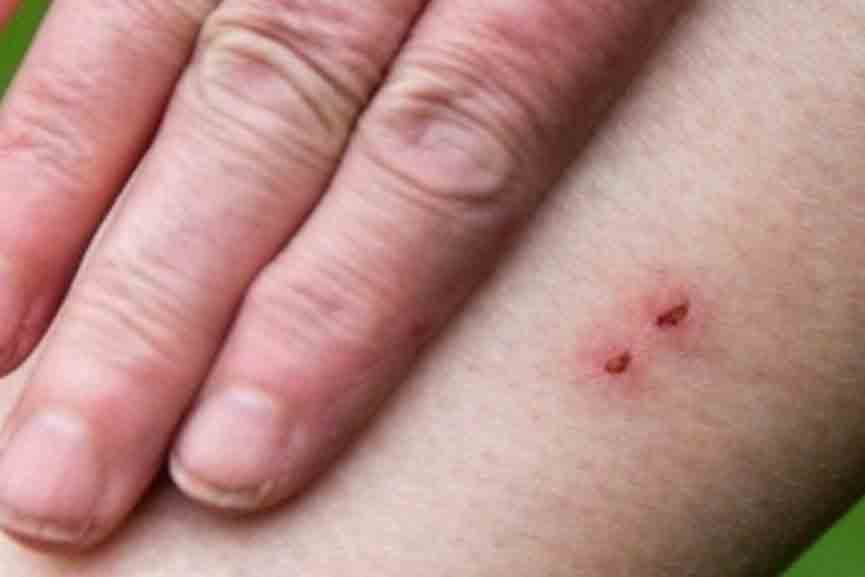 Snake-Bite A fourth class student was bitten by a snake in Vadakkancherry