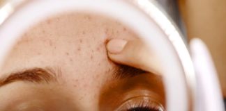 ബ്ളാക്ക് ഹെഡ്സ് അകറ്റാൻ ചില പൊടിക്കൈകള് ഇതാ