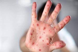 Monkey Pox Suspected In Kerala