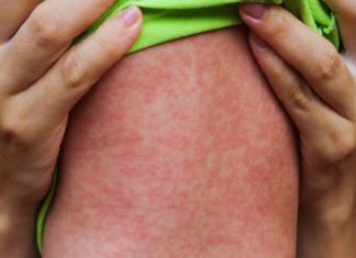 Measles spreads in Nadapuram; Immunity boost - special vaccination today