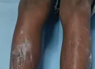 7-year-old boy was burnt with a shovel; Amma will be arrested today