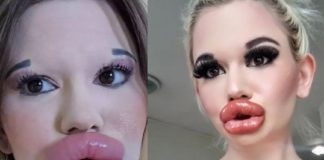 43 ലിപ് സർജറികൾ; ലോകത്തിലെ ഏറ്റവും വലിയ ചുണ്ടുള്ള സ്ത്രീ 43 lip surgeries; The woman with the biggest lips in the world