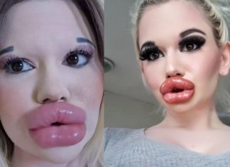 43 ലിപ് സർജറികൾ; ലോകത്തിലെ ഏറ്റവും വലിയ ചുണ്ടുള്ള സ്ത്രീ 43 lip surgeries; The woman with the biggest lips in the world