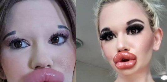 43 lip surgeries; The woman with the biggest lips in the world