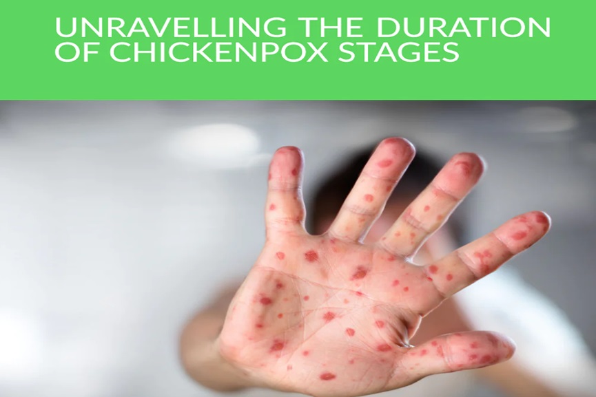 duration of chickenpox  