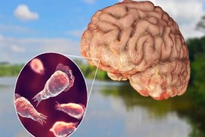 Amebic- encephalitis