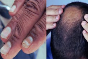 buldhana Unknown Disease