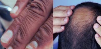 buldhana Unknown Disease