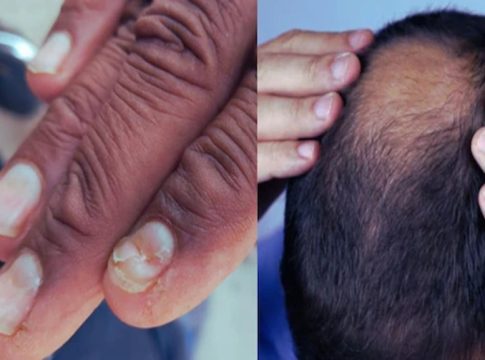 buldhana Unknown Disease