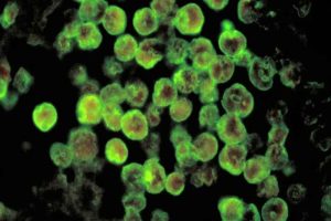 Amoebic Encephalitis