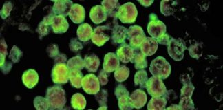 Amoebic Encephalitis
