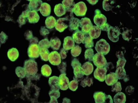 Amoebic Encephalitis
