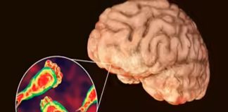 Amoeba disease