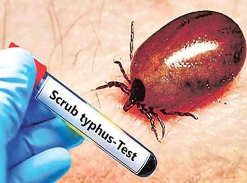 കൊയിലാണ്ടിയിൽ മരിച്ചയാൾക്ക് ചെള്ളുപനി, പ്രതിരോധ പ്രവർത്തനം ഊർജിതമാക്കി Scrub Typhus