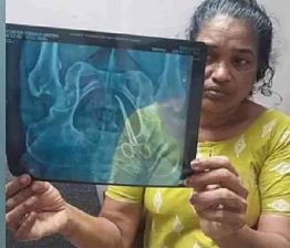 വയറ്റിൽ കത്രിക കുടുങ്ങിയ സംഭവം; ഡോക്ടർ ഷാഹിദയ്ക്ക് ക്ളീൻ ചിറ്റ് Usha Joseph