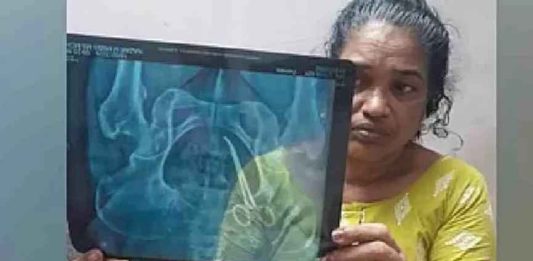 വയറ്റിൽ കത്രിക കുടുങ്ങിയ സംഭവം; ഉഷയുടെ ശസ്ത്രക്രിയ ഇന്ന്, ഡോക്ടർക്കെതിരെ കേസ് Usha Joseph