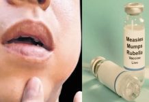 Mumps Outbreak