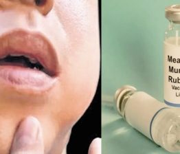 മുണ്ടിനീര് വ്യാപനം; ആലപ്പുഴ തുമ്പോളി സ്കൂളിന് 21 ദിവസം അവധി പ്രഖ്യാപിച്ചു Mumps Outbreak