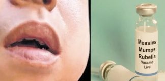 മുണ്ടിനീര് വ്യാപനം; ആലപ്പുഴ തുമ്പോളി സ്കൂളിന് 21 ദിവസം അവധി പ്രഖ്യാപിച്ചു Mumps Outbreak