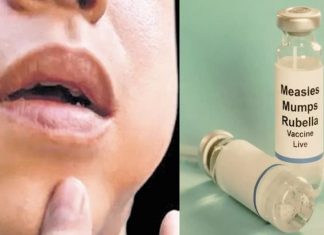 Mumps Outbreak