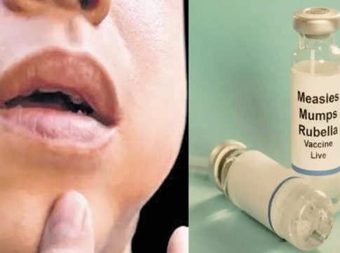Mumps Outbreak