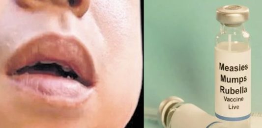 മുണ്ടിനീര് വ്യാപനം; ആലപ്പുഴ തുമ്പോളി സ്കൂളിന് 21 ദിവസം അവധി പ്രഖ്യാപിച്ചു Mumps Outbreak